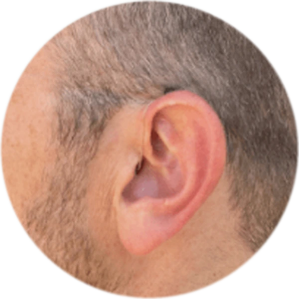 A receiver-in-canal hearing device worn in an ear